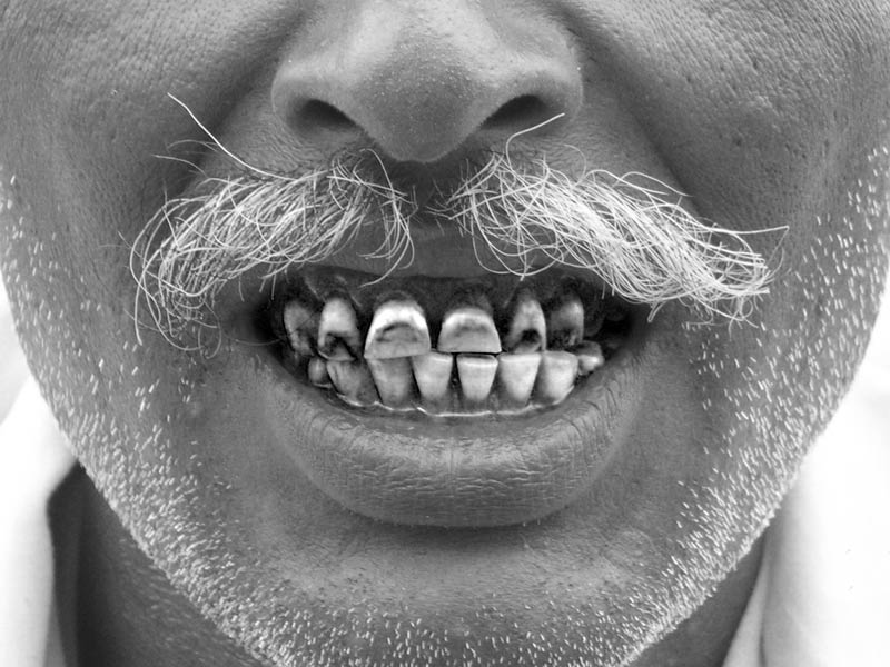 A middle-aged man affected by dental fluorosis due to drinking of fluoride-contaminated grounwater in Shivpuri district,  Madhya Pradesh